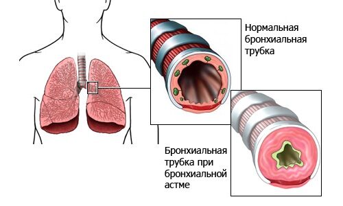 Как лечить бронхиальную астму