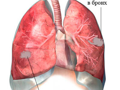 Симптомы и лечение абсцесса легкого
