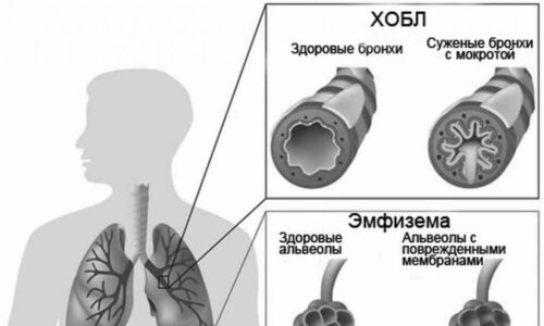 Заболевание хобл: что это такое и как лечится и диагностируется?