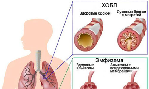 Способы лечения хобл в домашних условиях