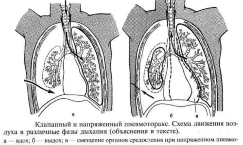 Симптомы и лечение пневмоторакса легкого