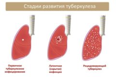 Инфильтративные формы туберкулеза легких: что это такое?